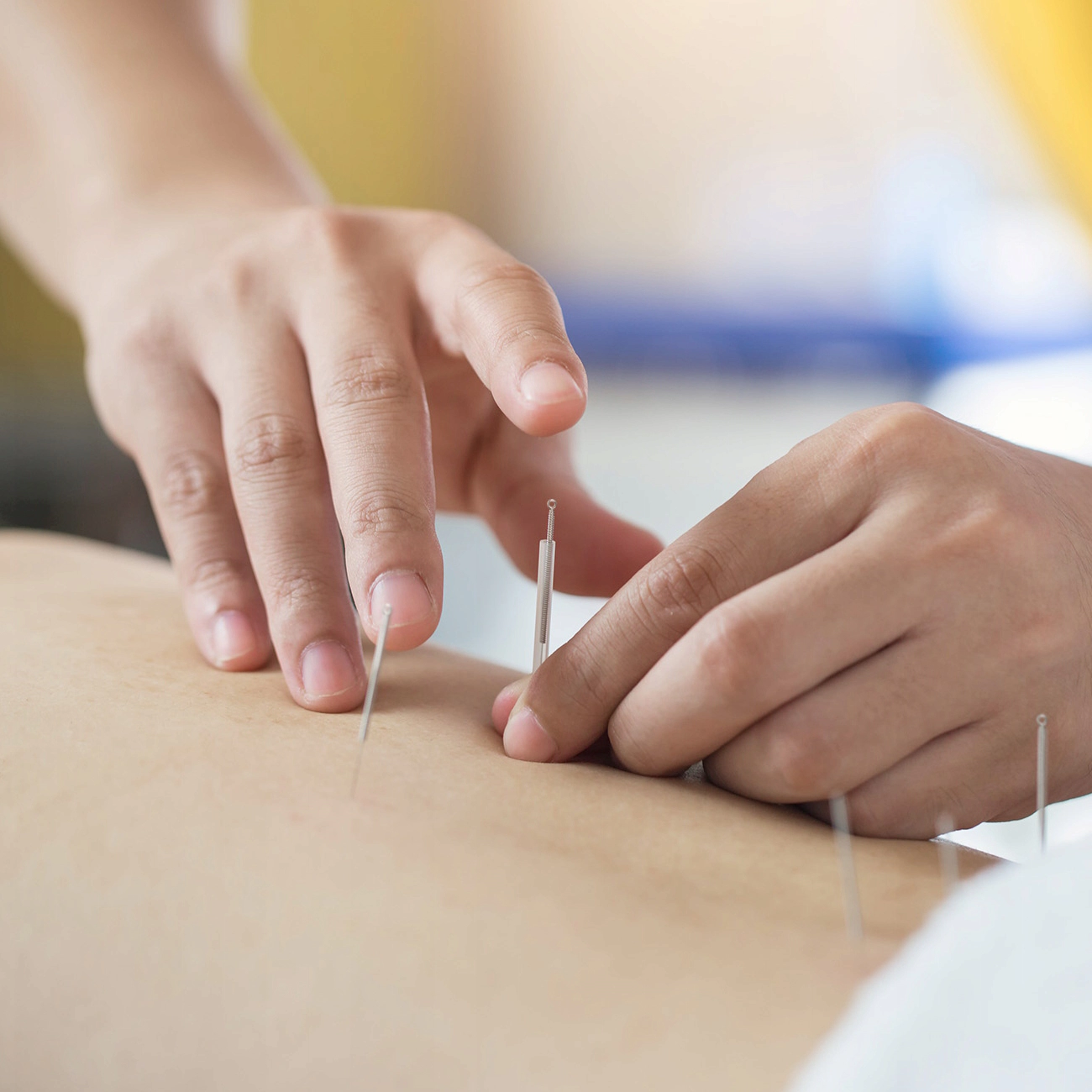 igly do akupunktury z prowadnica ze stali chirurgicznej