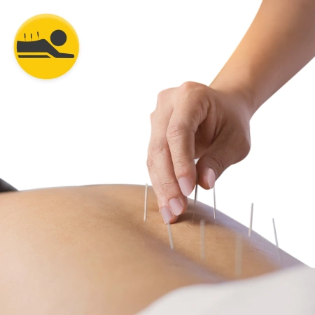 Vezetővel rendelkező akupunktúrás tűk, 100 db, 0,3 x 75 mm